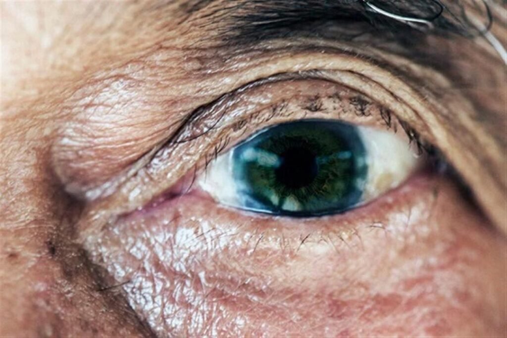 الضمور البقعي