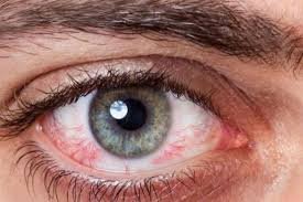 التهاب الشبكية الصباغي: الأسباب، الأعراض وطرق التعامل مع المرض