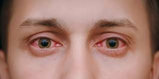 متلازمة كوغان