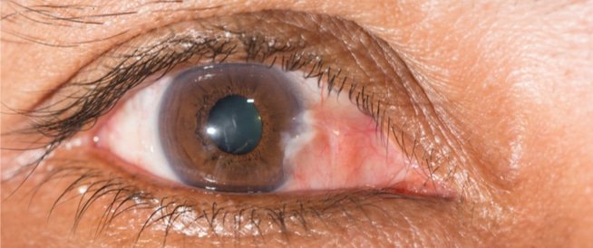 الظفرة العينية (Pterygium)