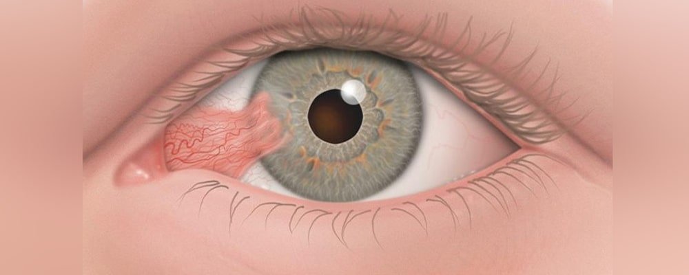 الظفرة العينية (Pterygium) الأسباب، الأعراض، وطرق الوقاية والعلاج