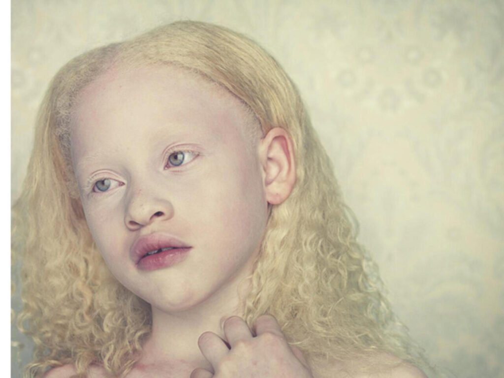 البرص العيني