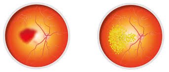 التنكس البقعي