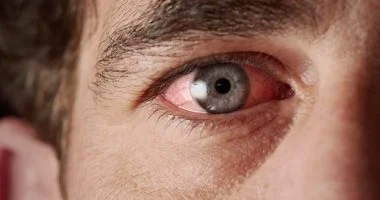 تشوش الرؤية