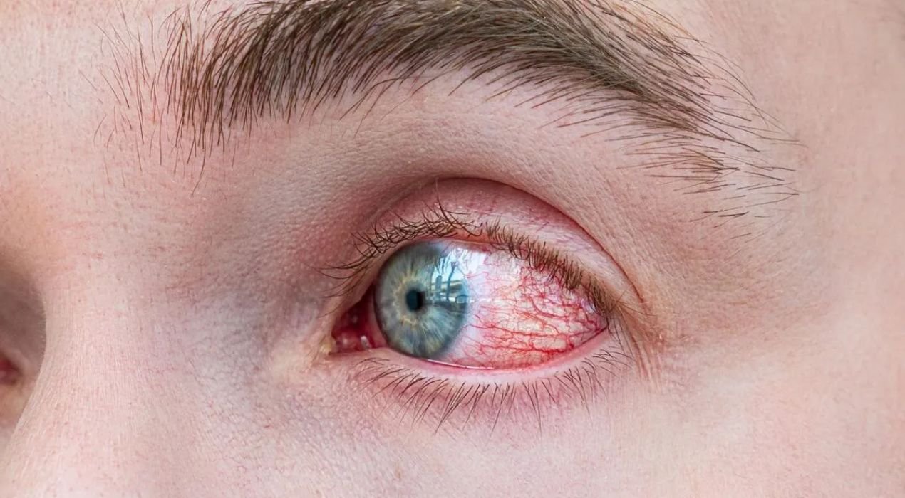 التهاب القرنية