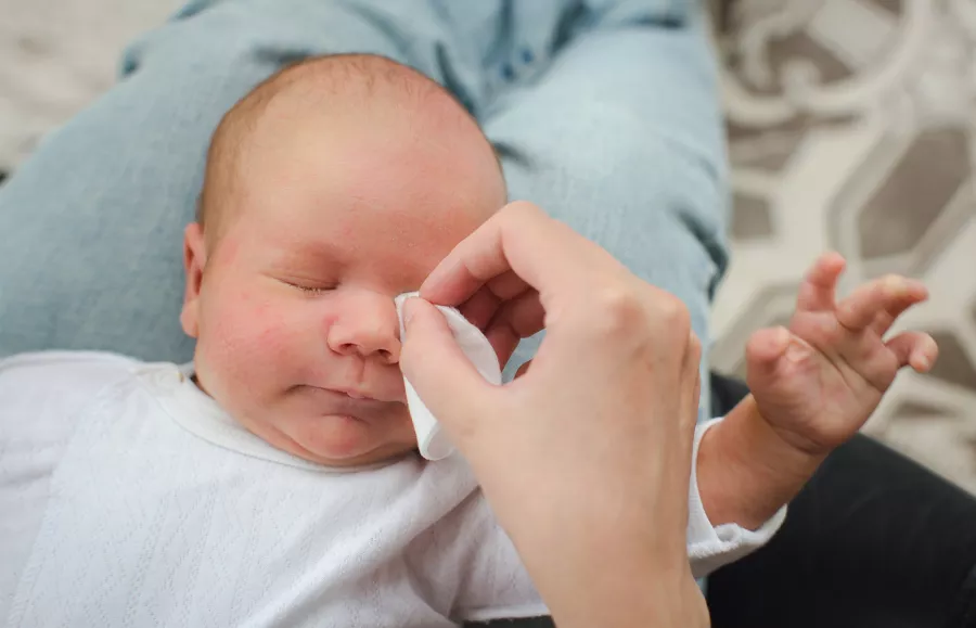 انسداد القناة الدمعية عند الرضع