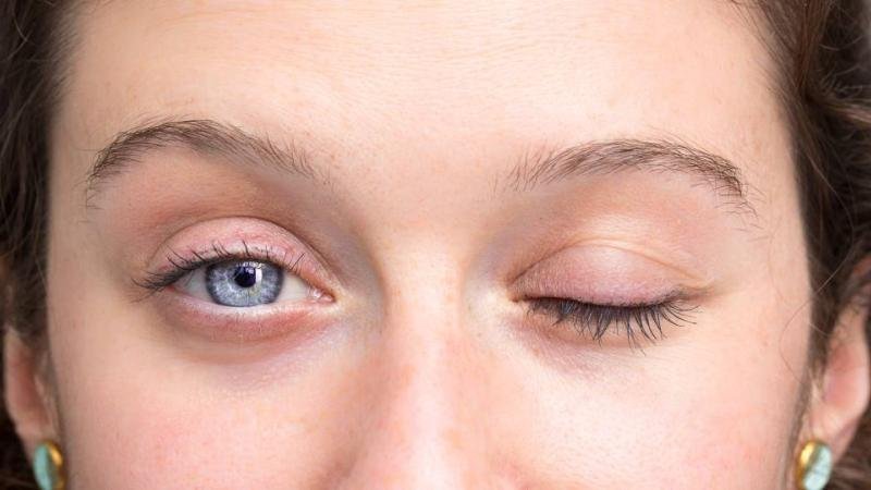 شلل عضلات العين