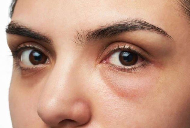 ما سبب انتفاخ الجفن في الصباح؟